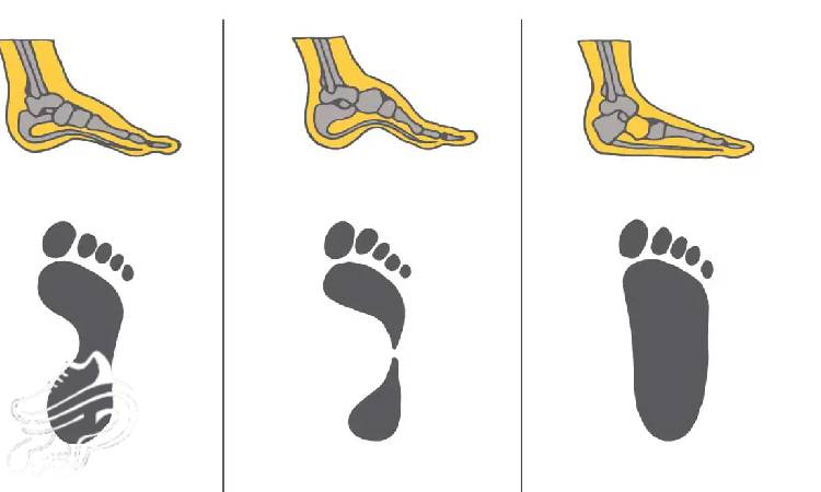 اهمیت فرم پا در انتخاب کتونی