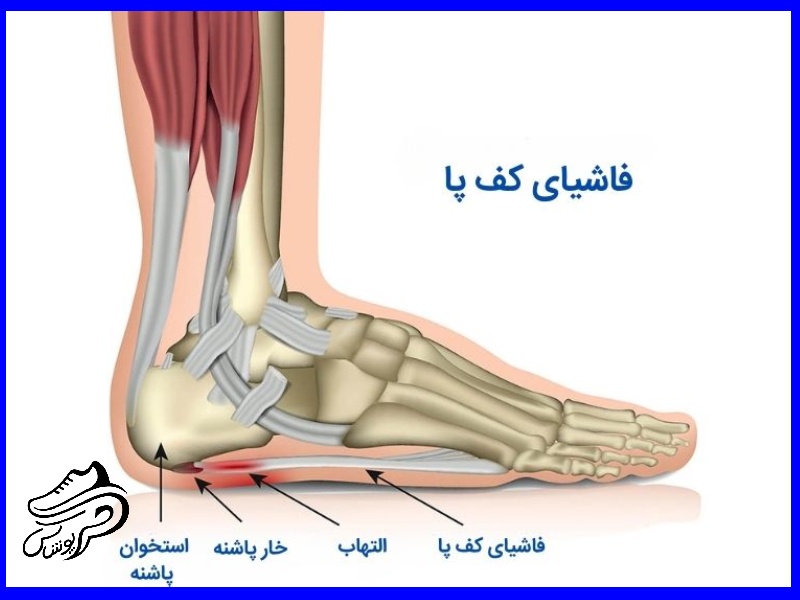 التهاب فاسیای کف پا (Plantar Fasciitis)