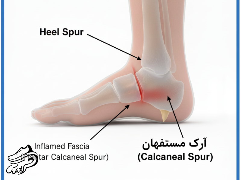  خار پاشنه (Heel Spur)