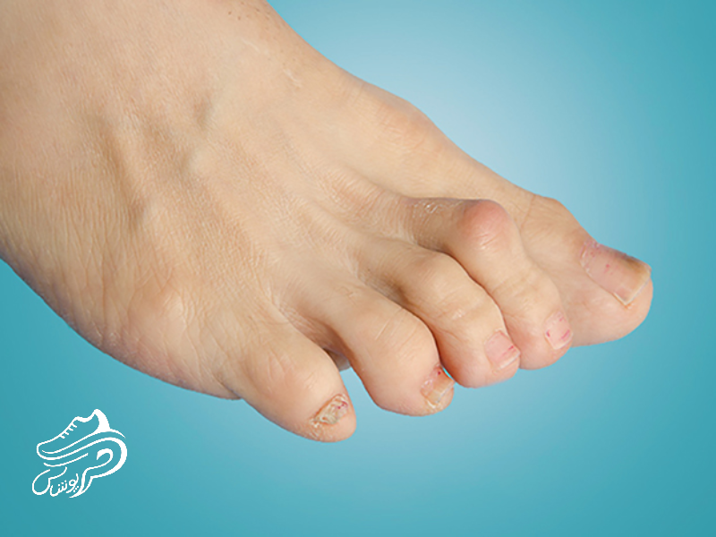 انگشت چکشی پا چیست و چگونه درمان می‌شود؟