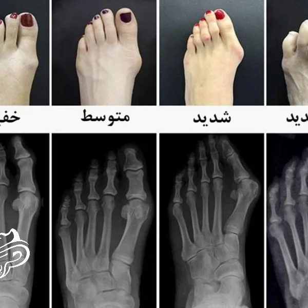 هالوکس والگوس چیست