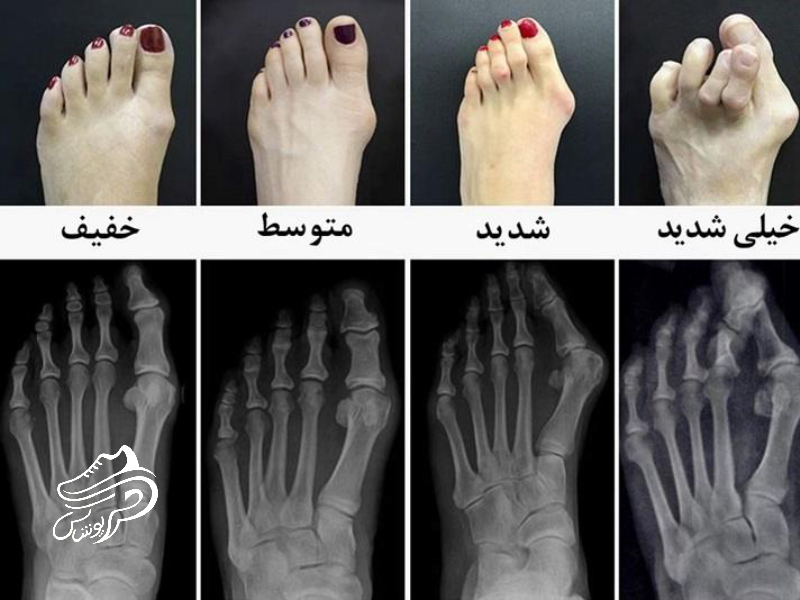 هالوکس والگوس چیست