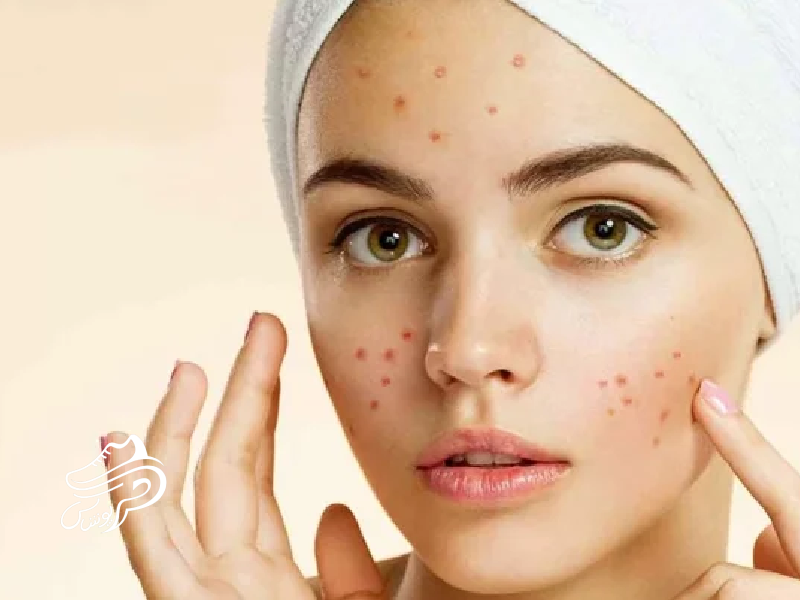 مراقبت‌های پوستی برای جلوگیری از جوش