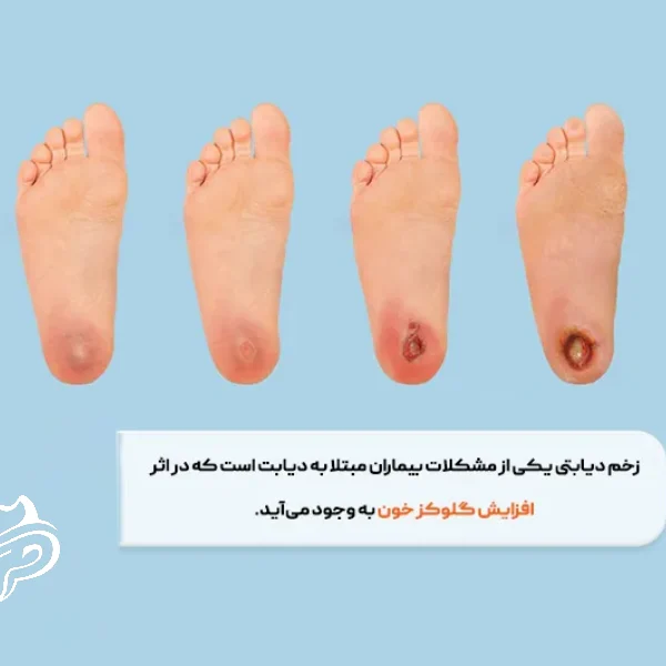 زخم پای دیابتی