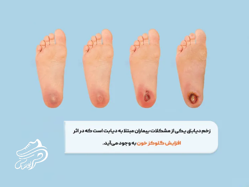 زخم پای دیابتی