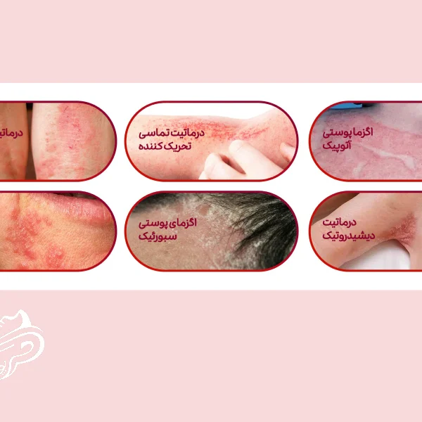 انواع اگزما و نکات طلایی برای پیشگیری و درمان