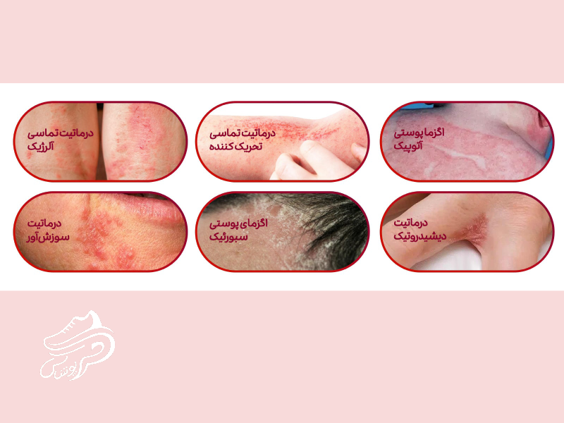 انواع اگزما و نکات طلایی برای پیشگیری و درمان